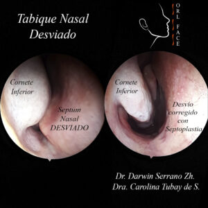 Dr. Darwin Serrano Zh. Dra. Carolina Tubay de S. OTORRINOLARINGÓLOGOS. otorrino Cirugía Estética y Funcional Nasal
