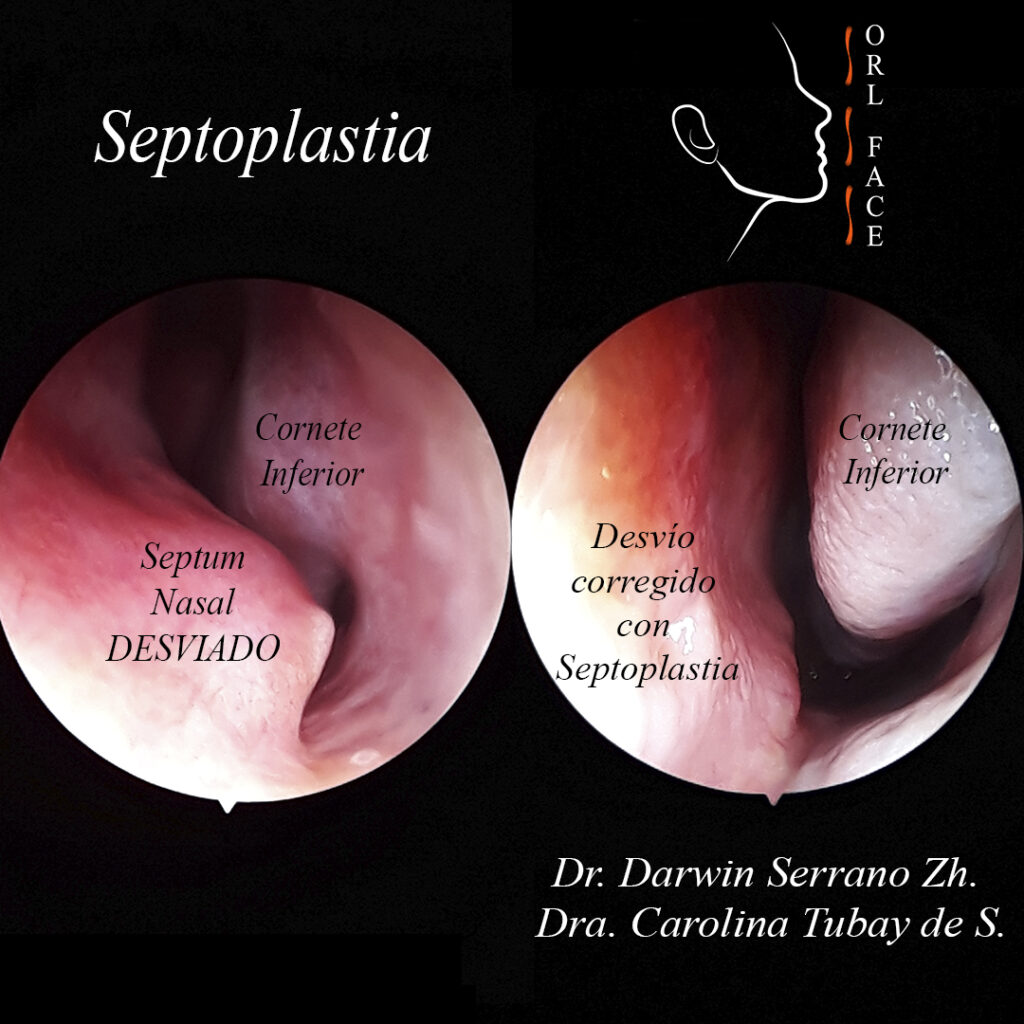 Dr. Darwin Serrano Zh. Dra. Carolina Tubay de S. OTORRINOLARINGÓLOGOS. otorrino Cirugía Estética y Funcional Nasal