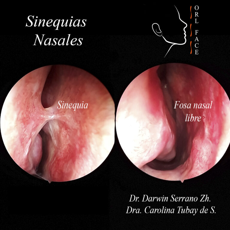 Dr. Darwin Serrano Zh. Dra. Carolina Tubay de S. OTORRINOLARINGÓLOGOS. otorrino Cirugía Estética y Funcional Nasal. OEL FACE