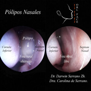 Dr. Darwin Serrano Zh. Dra. Carolina Tubay de S. OTORRINOLARINGÓLOGOS. otorrino Cirugía Estética y Funcional Nasal. OEL FACE