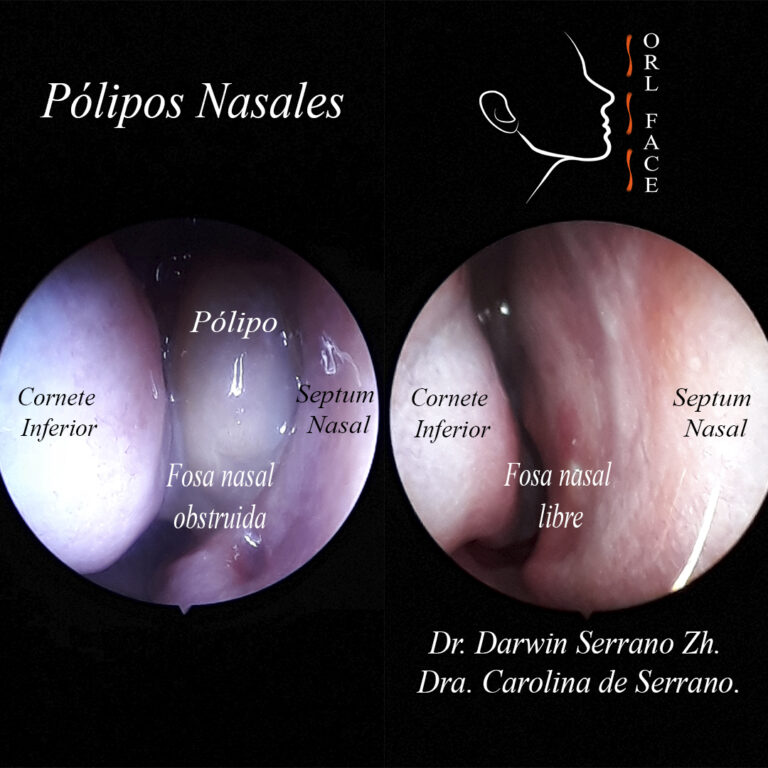 Dr. Darwin Serrano Zh. Dra. Carolina Tubay de S. OTORRINOLARINGÓLOGOS. otorrino Cirugía Estética y Funcional Nasal. OEL FACE