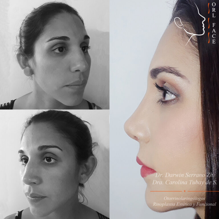 Dr. Darwin Serrano Zh. Dra. Carolina Tubay de S. Otorrinolagingologo, Otorrino. orlface. Manta. Salinas. Rhinoplasty.