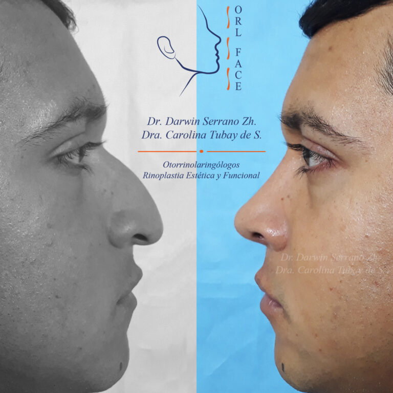 Dr. Darwin Serrano Zh. Dra. Carolina Tubay de S. Otorrinolagingologo, Otorrino. orlface. Manta. Salinas. Rinoplastia.