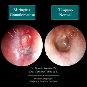 Dr. Darwin Serrano Zh. Dra. Carolina Tubay de S. Otorrino, orl face. Miringitis granulomatosa1