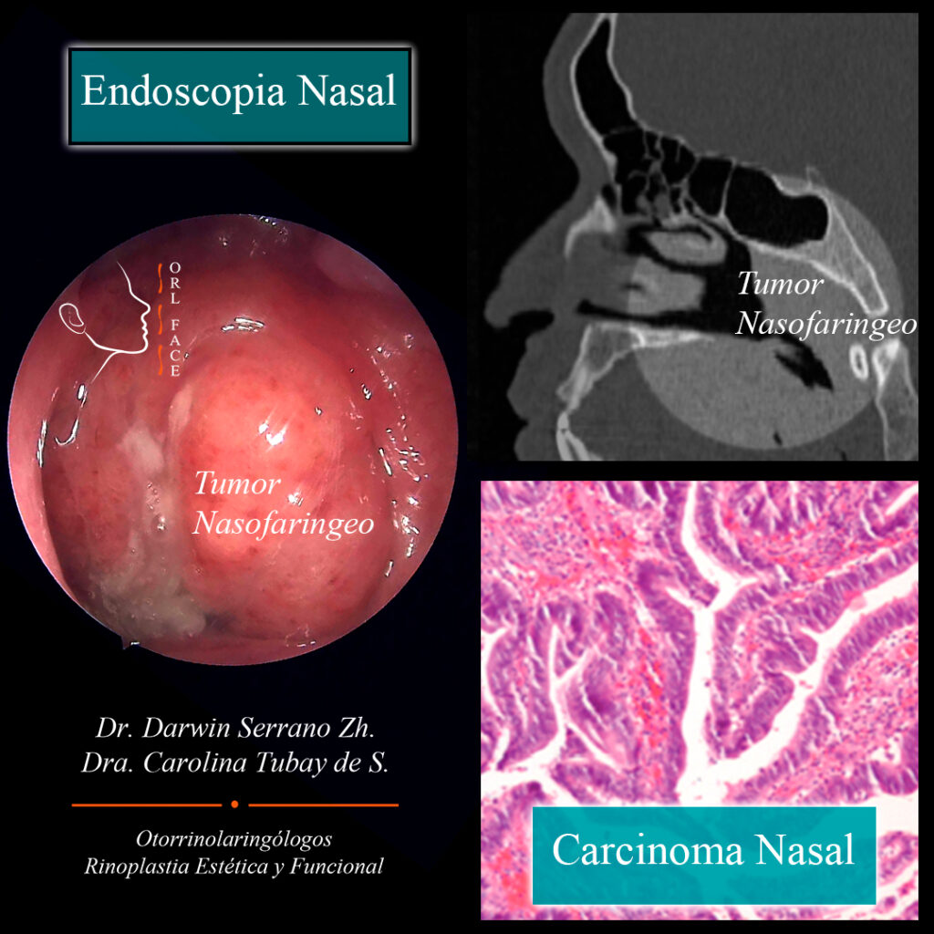Dr. Darwin Serrano Zh. Dra. Carolina Tubay de S. Otorrinolagingologo, Otorrino. orlface. Manta. Salinas. Rinoplastia. Tumor nasofaríngeo