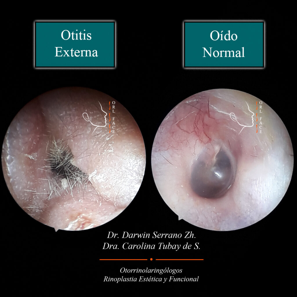 Dr. Darwin Serrano Zh. Dra. Carolina Tubay de S. Otorrinolagingologo, Otorrino. orlface. Manta. Salinas. Otitis Externa