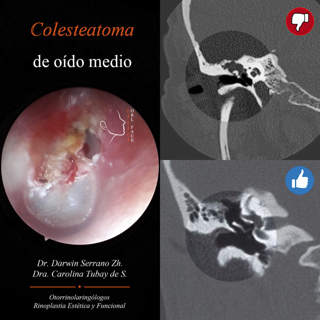 Dr. Darwin Serrano Zh. Dra. Carolina Tubay de S. Otorrinolagingologo, Otorrino. orlface. Manta. Salinas. Colesteatoma de oído medio
