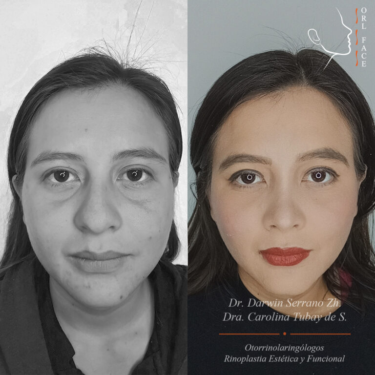 Dr. Darwin Serrano Zh. Dra. Carolina Tubay de S. Otorrinolagingologo, Otorrino. orlface. Manta. Salinas. Rinoplastia.
