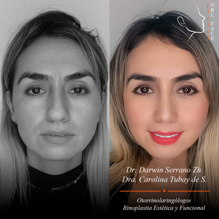 Dr. Darwin Serrano Zh. Dra. Carolina Tubay de S. Otorrinolagingologo, orlface. Salinas. Rinoplastia 1