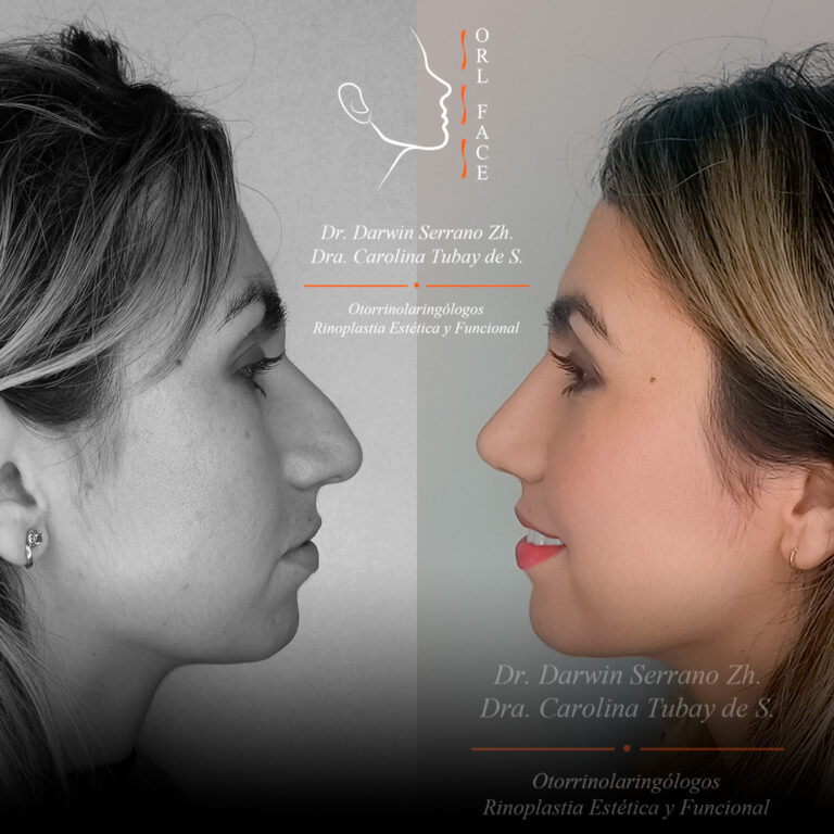 Dr. Darwin Serrano Zh. Dra. Carolina Tubay de S. Otorrinolagingologo, orlface. Salinas. Rinoplastia 10