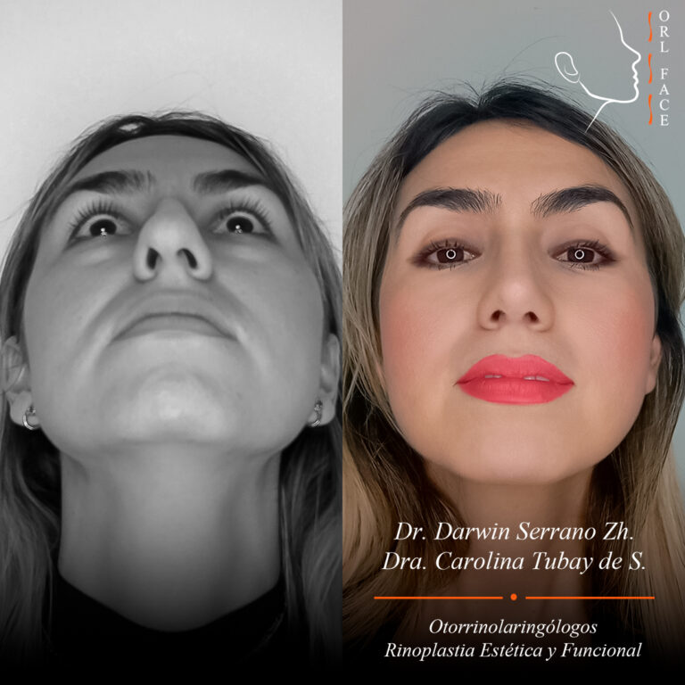 Dr. Darwin Serrano Zh. Dra. Carolina Tubay de S. Otorrinolagingologo, orlface. Salinas. Rinoplastia 4