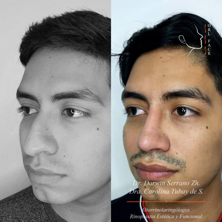 Dr. Darwin Serrano Zh. Dra. Carolina Tubay de S. Otorrinolagingologo, Otorrino. orlface. Manta. Salinas. Rinoplastia.