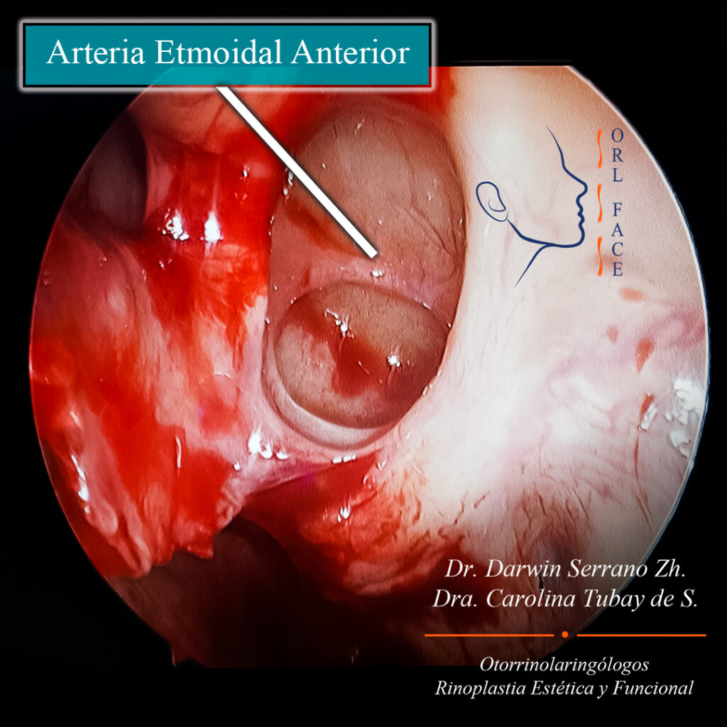 Dr. Darwin Serrano Zh. Dra. Carolina Tubay de S. Otorrinolaringologia, orl face, FESS Cirugía endoscópia nasal, arteria etmoidal anterior 1