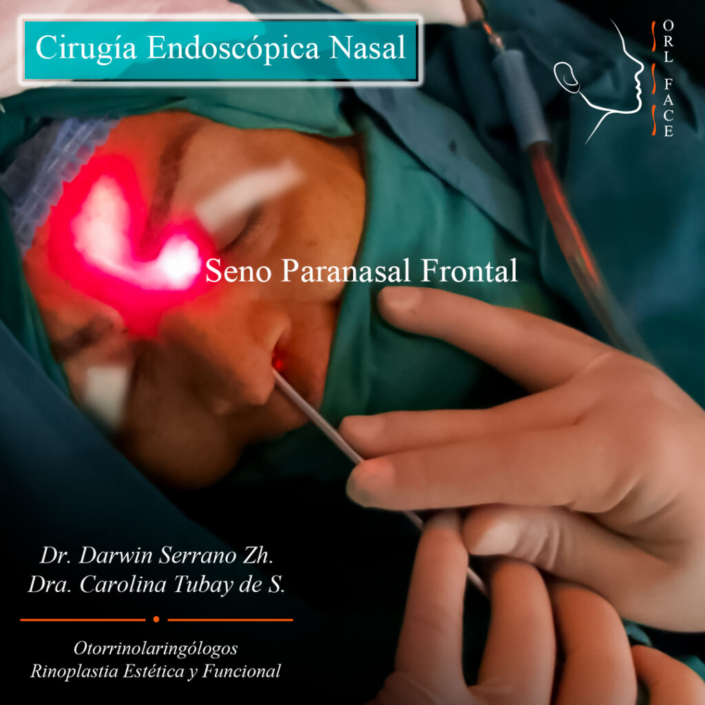 Dr. Darwin Serrano Zh. Dra. Carolina Tubay de S. Otorrinolaringologia, orl face, FESS Cirugía endoscópia nasal frantal