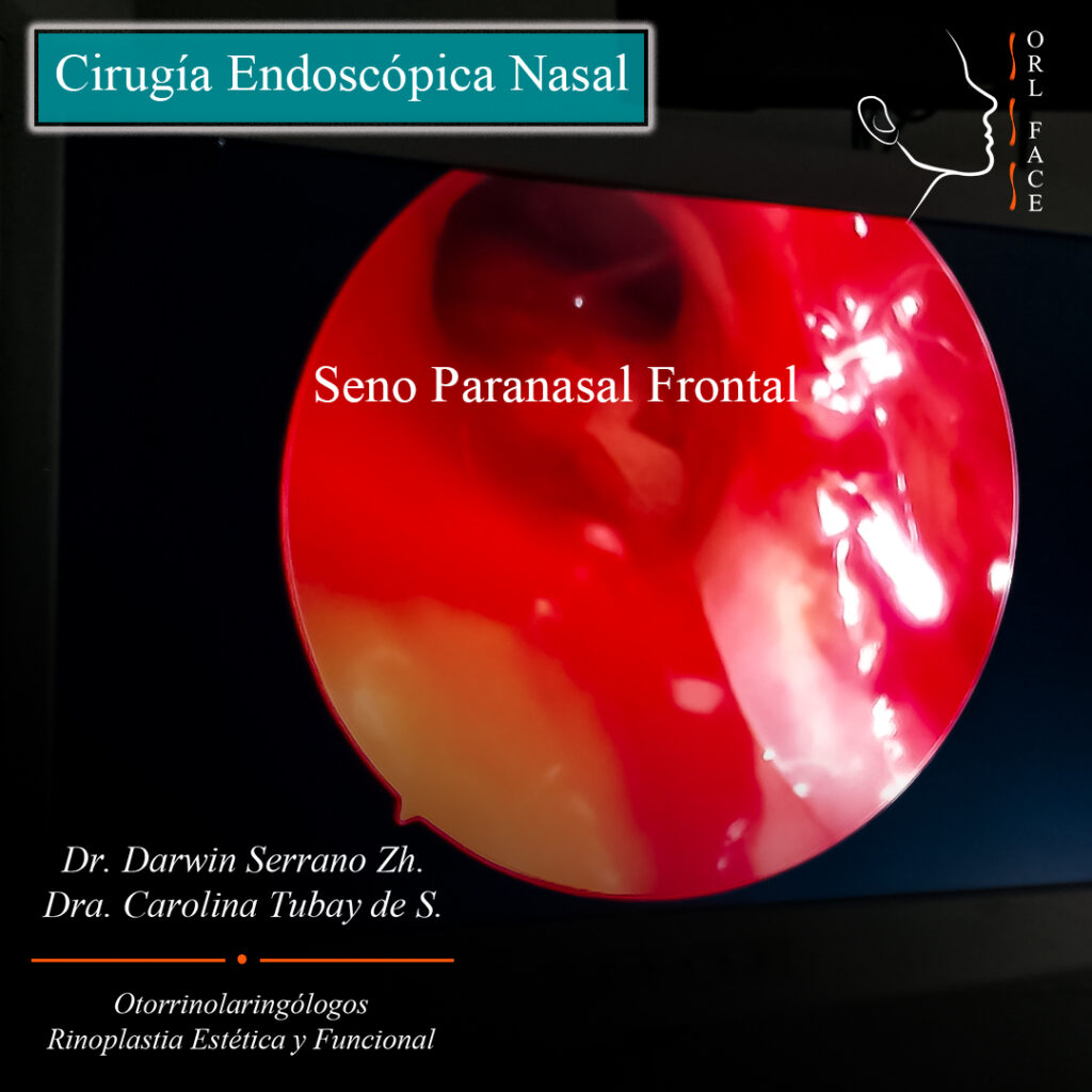 Dr. Darwin Serrano Zh. Dra. Carolina Tubay de S. Otorrinolaringologia, orl face, FESS Cirugía endoscópica nasal seno frontal