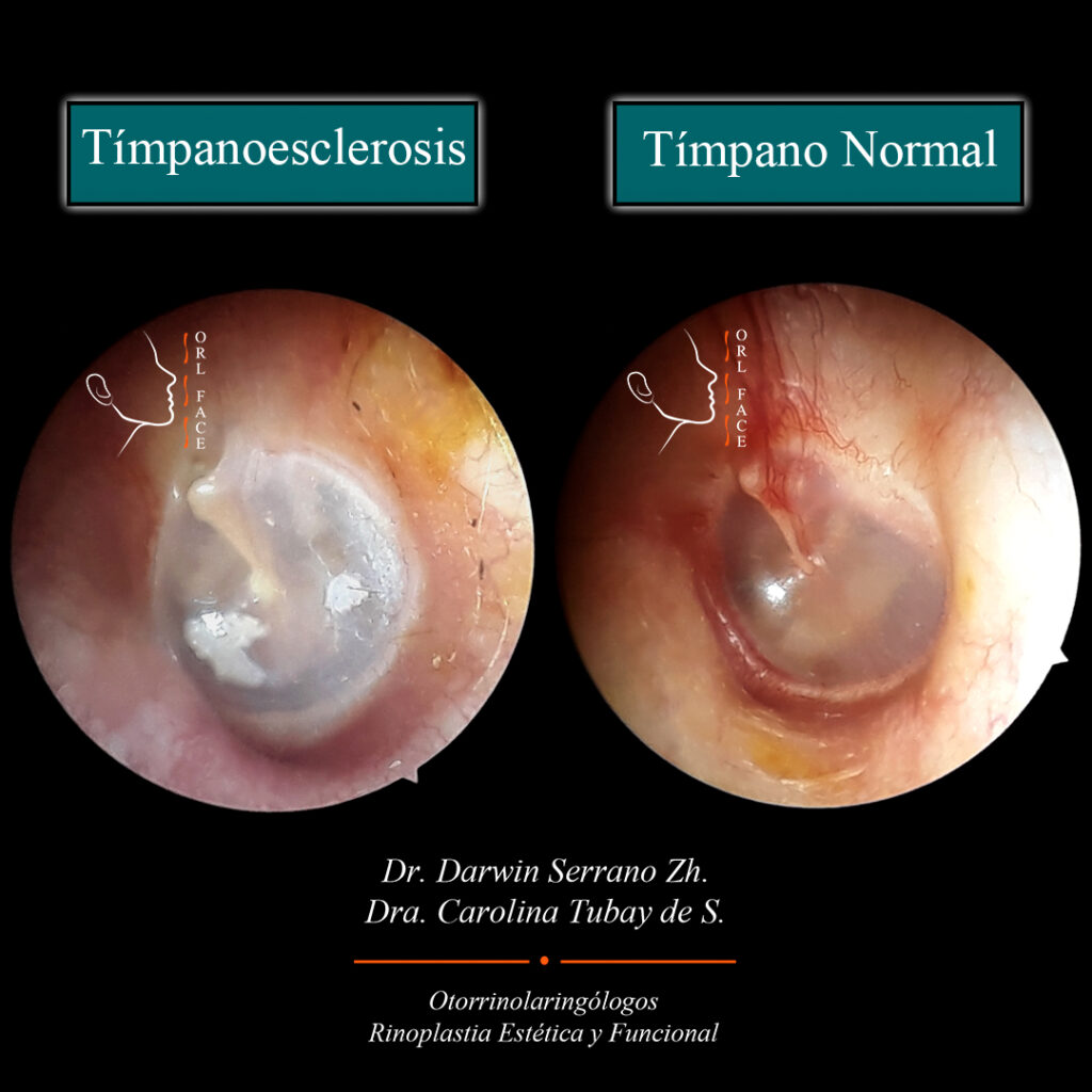 Dr. Darwin Serrano Zh. Dra. Carolina Tubay de S. Otorrinolaringologo,orl face. Timpanoescrerosis