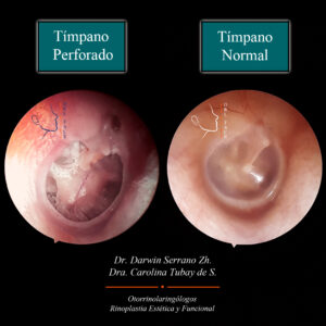 Dr. Darwin Serrano Zh. Dra. Carolina Tubay de S. Otorrinolaringologo,orl face.Timpano perforado1