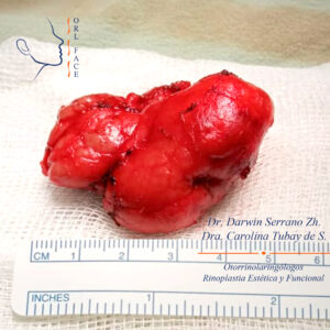 Dr. Darwin Serrano Zh. Dra. Carolina Tubay de S. Otorrinolagingologo, Otorrino. orlface. Manta. Salinas. Tumor de Glándulas Salival (Submaxilectomía):