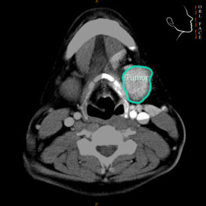 Dr. Darwin Serrano Zh. Dra. Carolina Tubay de S. Otorrinolagingologo, Otorrino. orlface. Manta. Salinas. Tumor de Glándulas Salival (Submaxilectomía):