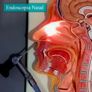 Endoscopia nasal en esquema