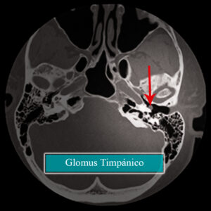 Glomus timpánico TC axial