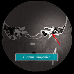 Glomus timpánico TC coronal