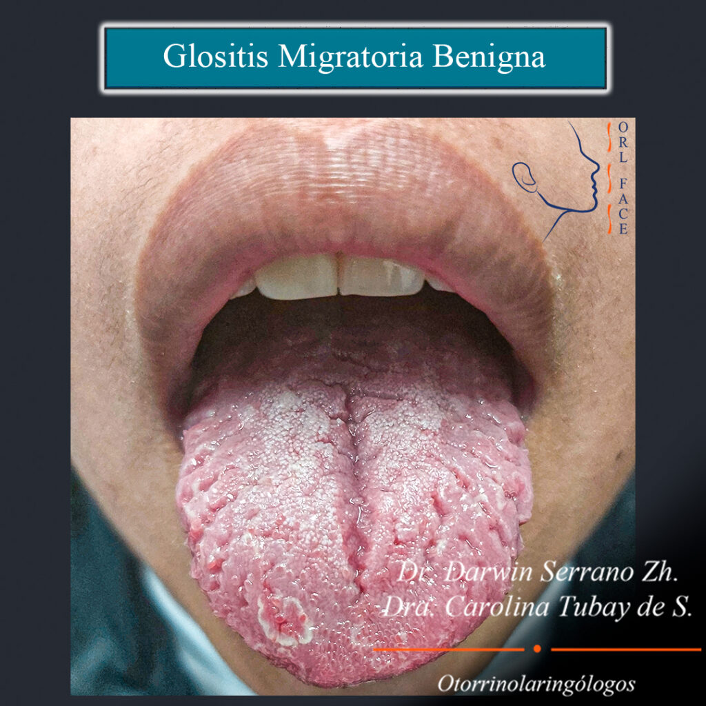 Glositis migratoria benigna Dr. Darwin Serrano Zh. Dra. Carolina Tubay de S. Otorrinolagingologo, orlface. Salinas.
