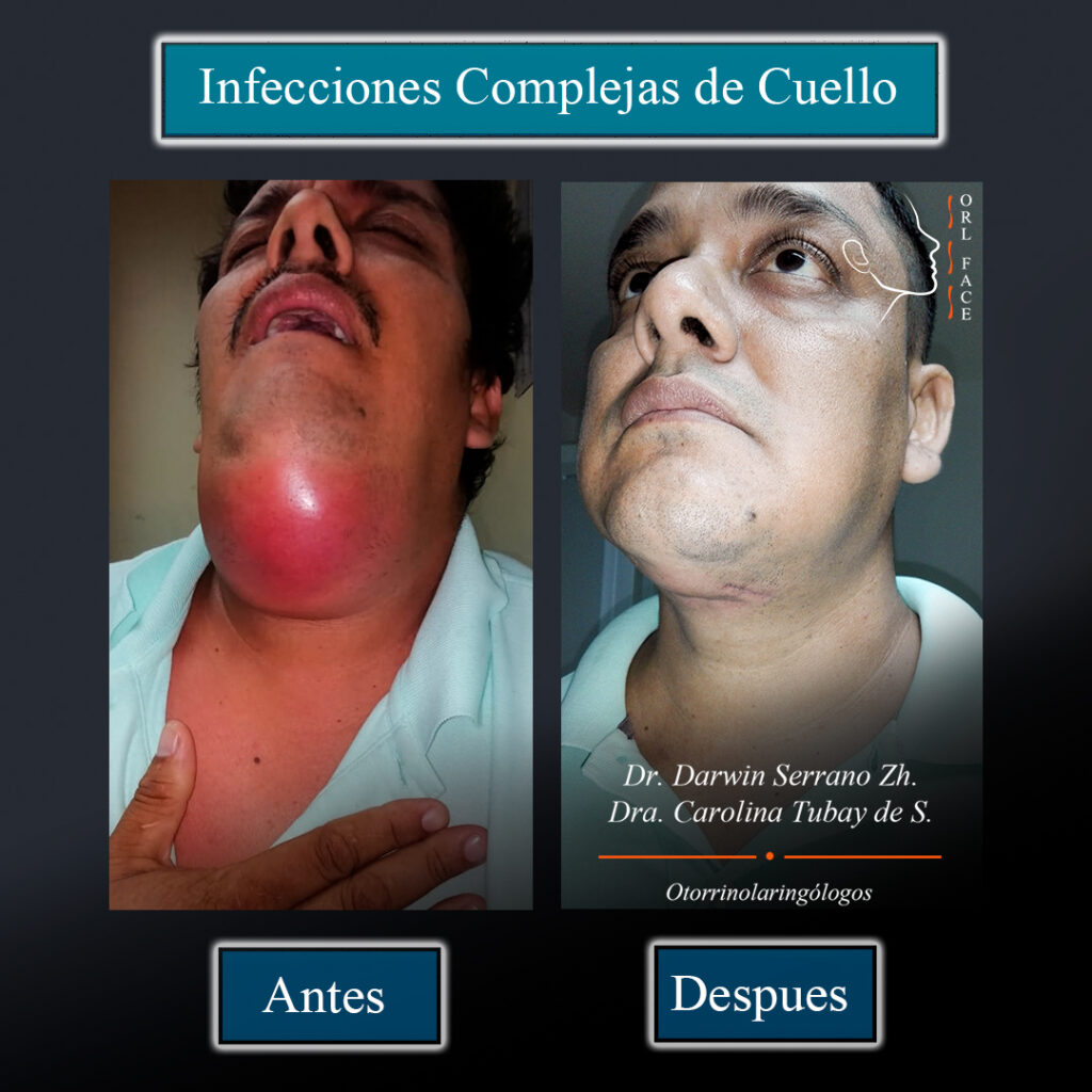 Infecciones complejas de cuello Dr. Darwin Serrano Zh. Dra. Carolina Tubay de S. Otorrinolagingologo, orlface. Salinas.