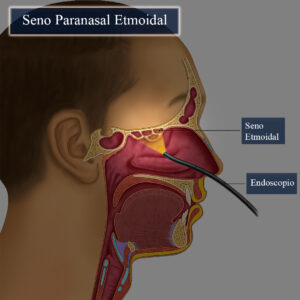 Seno paranasal Etmoidal en 3D