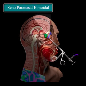 Seno paranasal Etmoidal en esquema