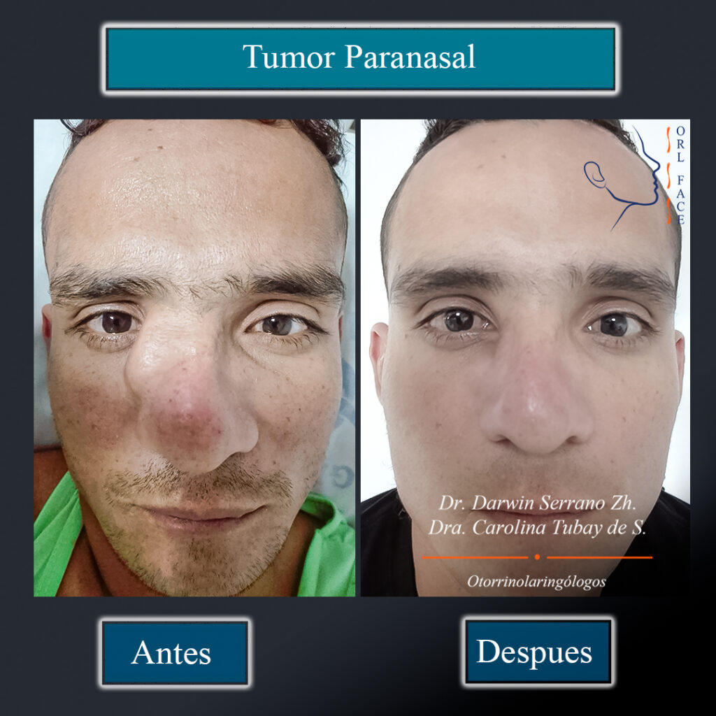 Tumor de nariz y paranasal Dr. Darwin Serrano Zh. Dra. Carolina Tubay de S. Otorrinolagingologo, orlface. Salinas.
