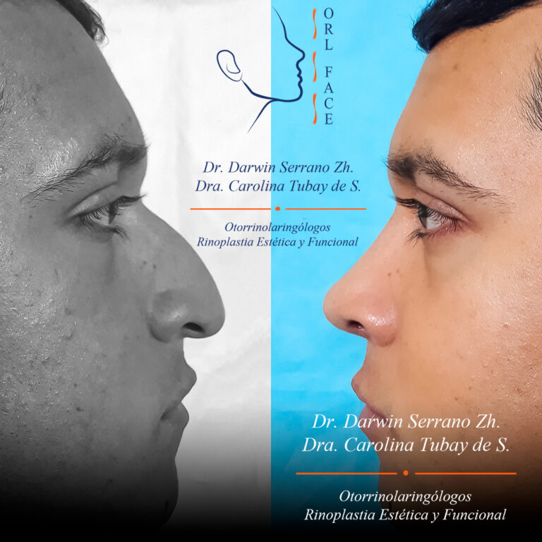 Dr. Darwin Serrano Zh. Dra. Carolina Tubay de S. Otorrinolagingologo, Otorrino. orlface. Manta. Salinas. Rinoplastia. garganta1 orlface