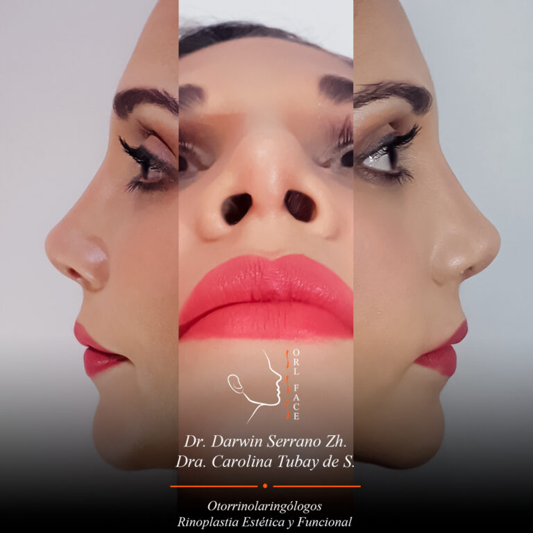 Otorrinolagingologo, Otorrino. orlface. santa elena. Salinas. Rinoplastia.