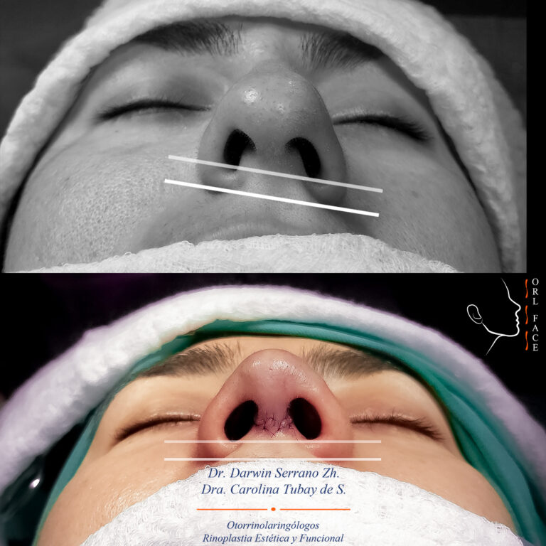 Dr. Darwin Serrano Zh. Dra. Carolina Tubay de S. Otorrinolagingologo, Otorrino. orlface. Manta. Salinas. Rinoplastia.