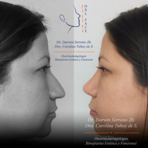 Dr. Darwin Serrano Zh. Dra. Carolina Tubay de S. Otorrinolagingologo, Otorrino. orlface. Manta. Salinas. Rinoplastia.