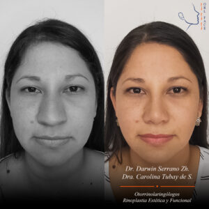 Dr. Darwin Serrano Zh. Dra. Carolina Tubay de S. Otorrinolagingologo, Otorrino. orlface. Manta. Salinas. Rinoplastia.