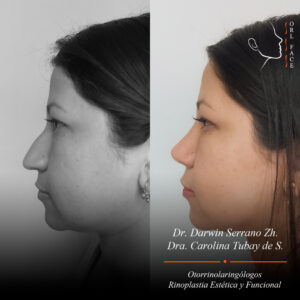 Dr. Darwin Serrano Zh. Dra. Carolina Tubay de S. Otorrinolagingologo, Otorrino. orlface. Manta. Salinas. Rinoplastia.