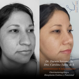 Dr. Darwin Serrano Zh. Dra. Carolina Tubay de S. Otorrinolagingologo, Otorrino. orlface. Manta. Salinas. Rinoplastia.