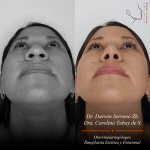 Dr. Darwin Serrano Zh. Dra. Carolina Tubay de S. Otorrinolagingologo, Otorrino. orlface. Manta. Salinas. Rinoplastia.