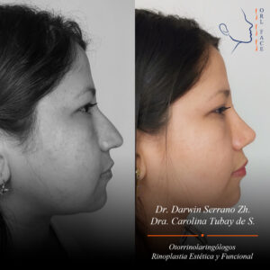 Dr. Darwin Serrano Zh. Dra. Carolina Tubay de S. Otorrinolagingologo, Otorrino. orlface. Manta. Salinas. Rinoplastia.
