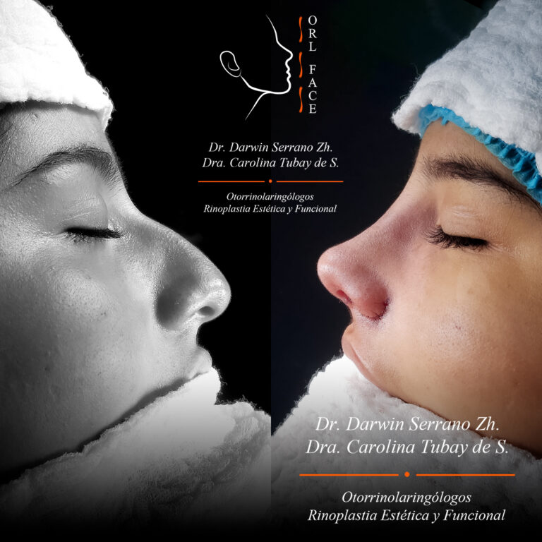 Dr. Darwin Serrano Zh. Dra. Carolina Tubay de S. Otorrinolagingologo, Otorrino. orlface. Manta. Salinas. Rinoplastia.