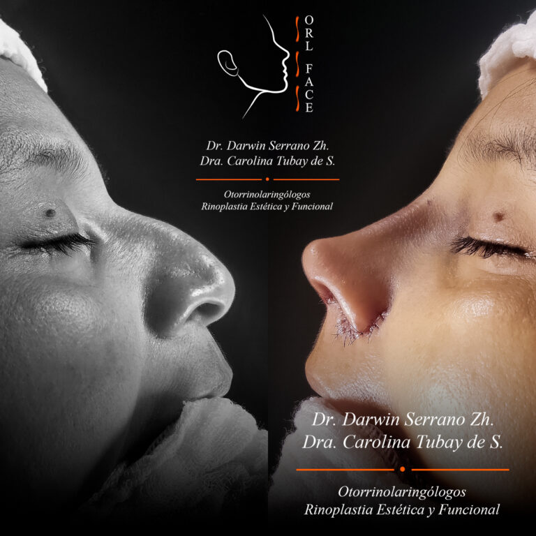 Dr. Darwin Serrano Zh. Dra. Carolina Tubay de S. Otorrinolagingologo, Otorrino. orlface. Manta. Salinas. Rinoplastia.