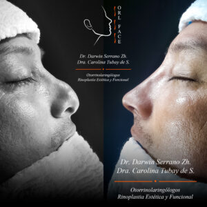 Dr. Darwin Serrano Zh. Dra. Carolina Tubay de S. Otorrinolagingologo, Otorrino. orlface. Manta. Salinas. Rinoplastia.
