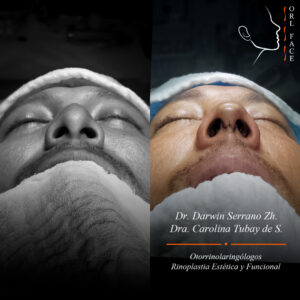 Dr. Darwin Serrano Zh. Dra. Carolina Tubay de S. Otorrinolagingologo, Otorrino. orlface. Manta. Salinas. Rinoplastia.
