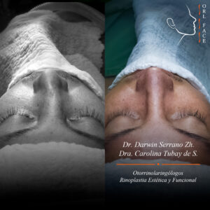 Dr. Darwin Serrano Zh. Dra. Carolina Tubay de S. Otorrinolagingologo, Otorrino. orlface. Manta. Salinas. Rinoplastia.
