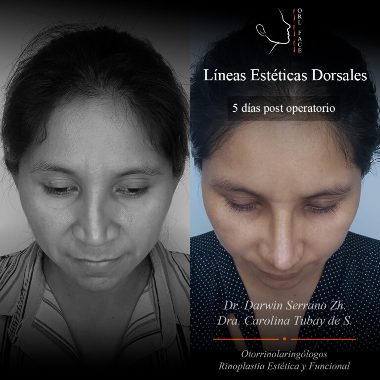 Dr. Darwin Serrano Zh. Dra. Carolina Tubay de S. Otorrinolagingologo, Otorrino. orlface. Manta. Salinas. Rinoplastia.