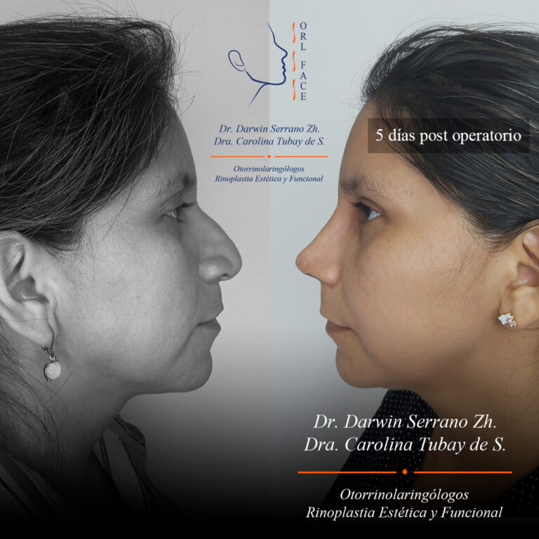 Dr. Darwin Serrano Zh. Dra. Carolina Tubay de S. Otorrinolagingologo, Otorrino. orlface. Manta. Salinas. Rinoplastia.