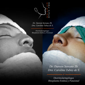 Dr. Darwin Serrano Zh. Dra. Carolina Tubay de S. Otorrinolagingologo, Otorrino. orlface. Manta. Salinas. Rinoplastia.