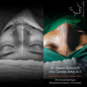 Dr. Darwin Serrano Zh. Dra. Carolina Tubay de S. Otorrinolagingologo, Otorrino. orlface. Manta. Salinas. Rinoplastia.