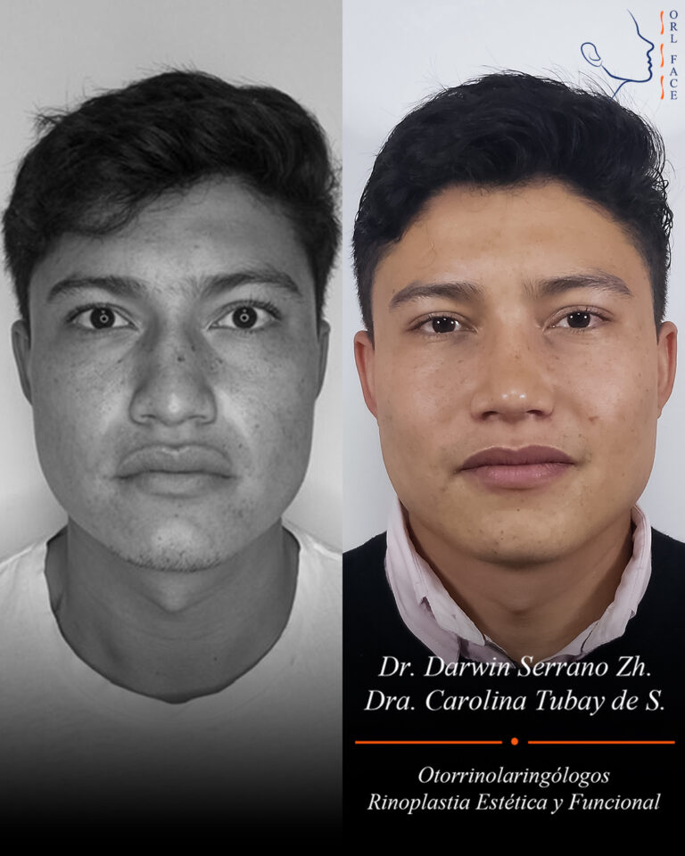 Dr. Darwin Serrano Zh. Dra. Carolina Tubay. Otorrinolaringologo, Otorrino. Salinas. Cirugia estetica nasal.